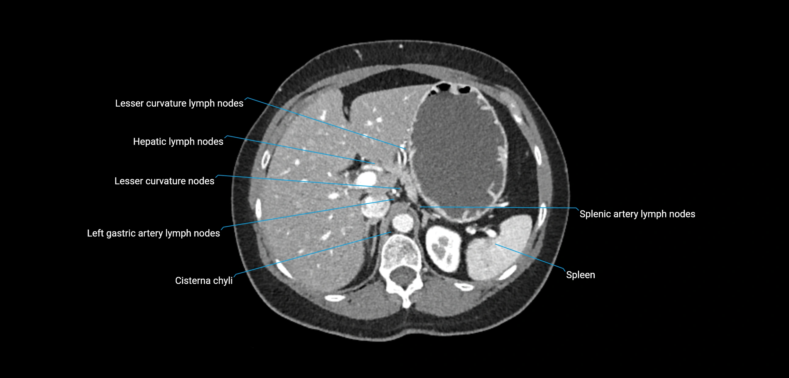 CT ct abdominal lymph nodes  axial cross sectional anatomy  enchanced radiology image -img-00002-00132.webp